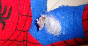 SpiderMan clearly required some microsurgery to his arm